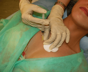 Mezokokteilio įvedimas į krūties audinį – alternatyva hialurono rūgšties injekcijoms