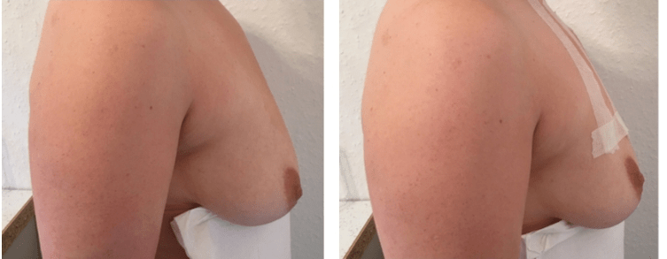 Prieš ir po sriegio krūtų pakėlimas