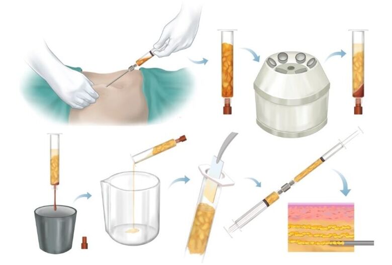 Riebalų pašalinimas iš probleminių vietų, apdorojimas ir injekcija į krūties audinį