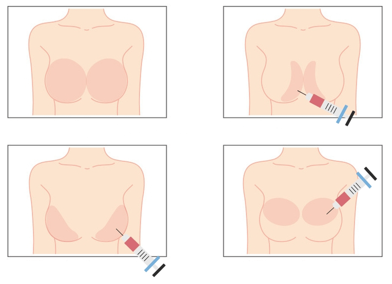Vietos hialurono rūgšties injekcijoms į krūtį