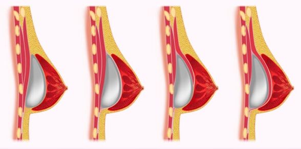 krūtų didinimo implantų montavimo būdai